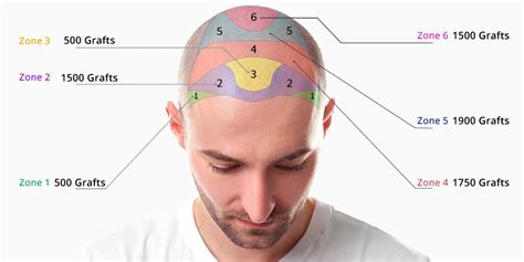 Haartransplantatie: De Evolutie Van Behandelmethoden