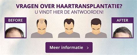 Haartransplantatie: De Meest Stelde Vragen Beantwoord