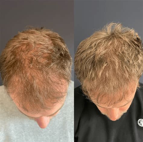 Verlies Van Haar Na Haartransplantatie: Wat Te Doen