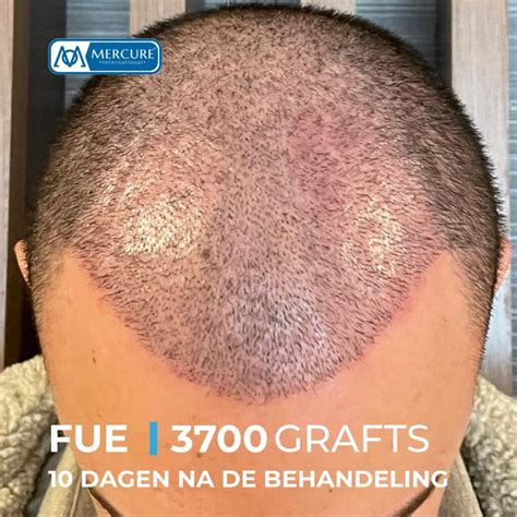 Waarom Kiezen Voor Saffier FUE Haartransplantatie?