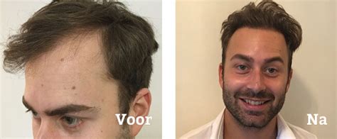 Hoe Langer Te Genieten Van Je Haartransplantatie Resultaten