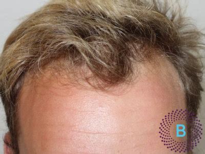 De Meest Gevaarlijke Fouten Bij Haartransplantatie