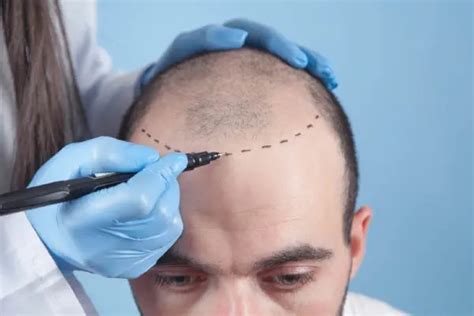 Wat Te Verwachten Tijdens Een Haartransplantatie Behandeling