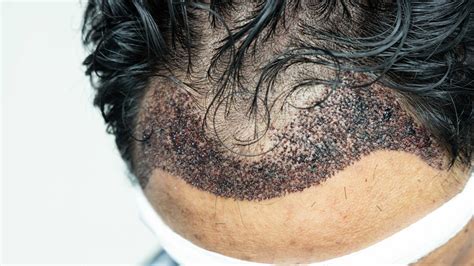 Zelfvertrouwen Terugkrijgen Met Haartransplantatie