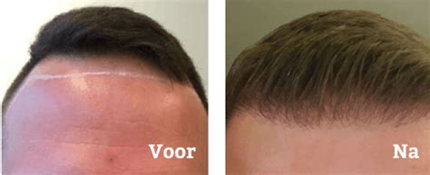 Haartransplantatie Procedure Uitleg