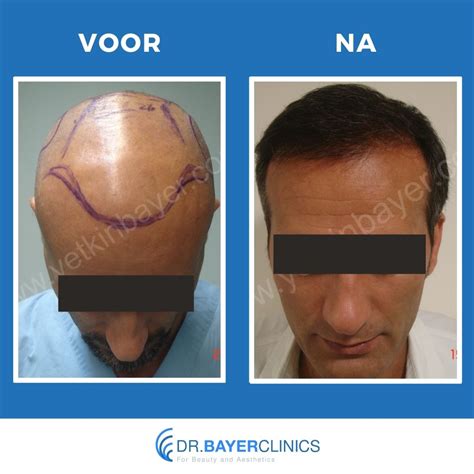 Haartransplantatie Voor En Na Foto's: Inspiratie Voor Jou