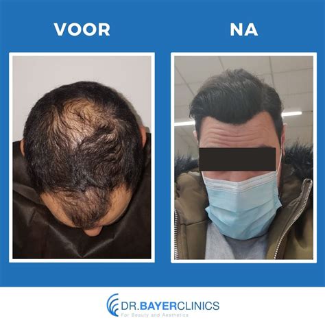 Haartransplantatie: Voor En Na Foto’s