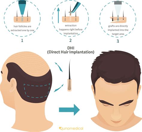 Haartransplantatie Technieken: DHI Vs. FUE