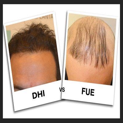 Haartransplantatie DHI Vs. FUE: Wat Is Het Verschil?