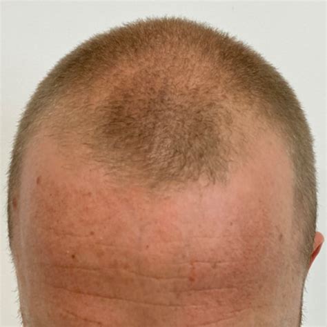 Haartransplantatie Resultaten: Binnen Welke Tijd Te Verwachten?