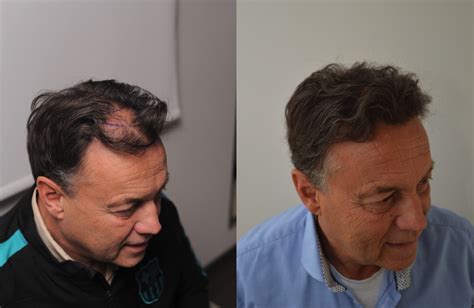 Haartransplantatie Voor Mannen: Specifieke Overwegingen