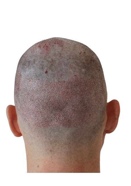 Herstelproces Na Haartransplantatie: Wat Te Verwachten