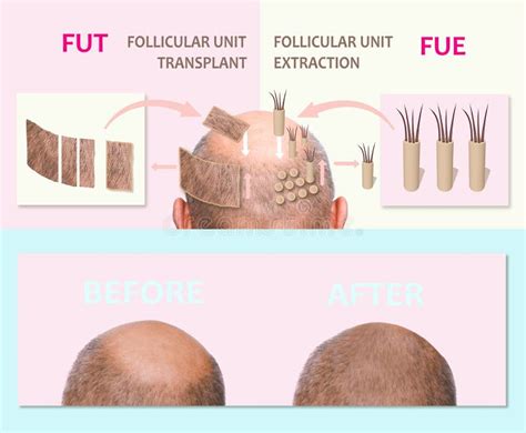 Verkenning Van Haartransplantatie Methodes: FUE, FUT En DHI