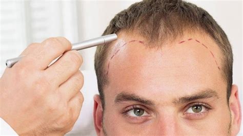 Beste Haartransplantatie Methoden In Overzicht