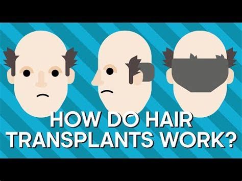 De Geschiedenis Van Haartransplantatie En Evolutie