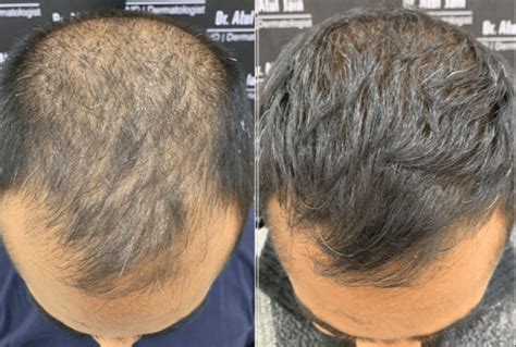 Haartransplantatie Behandeling: Alles Wat U Moet Weten