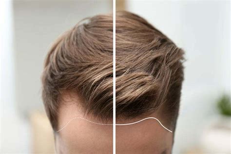 Haartransplantatie Bij Alopecia: Een Effectieve Oplossing