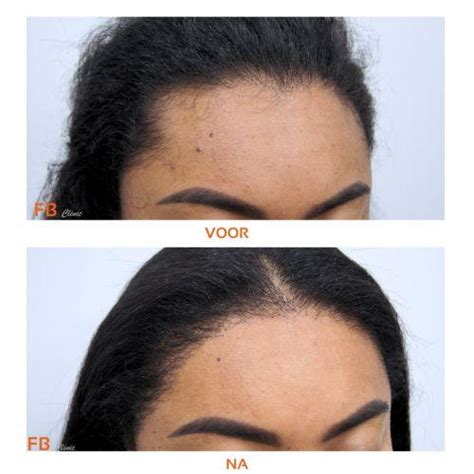 Haartransplantatie Voor Vrouwen: Mogelijkheden En Beperkingen