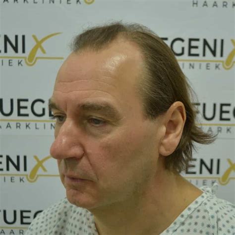 Is Haartransplantatie De Juiste Keuze Voor Jou?