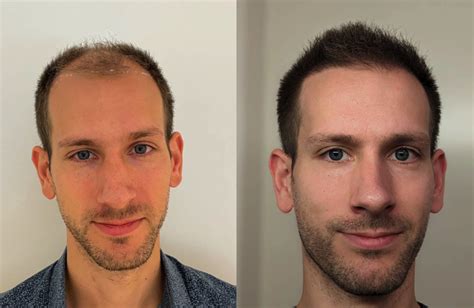 Voor En Na: Resultaten Van Haartransplantatie