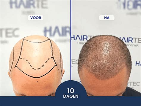 Wat Te Verwachten Bij Een Haartransplantatie Procedure